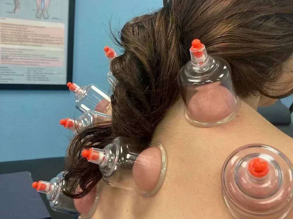 Cupping set placed across a patient’s upper back