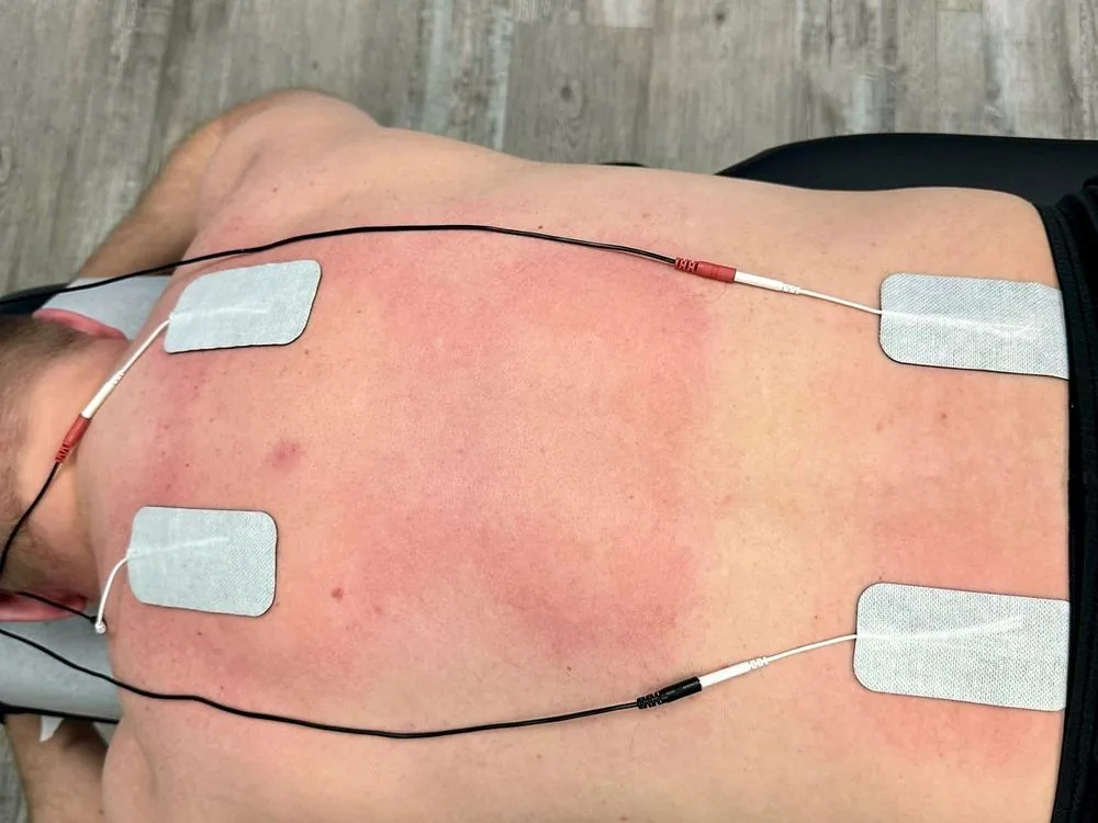 Electrical muscle stimulation pads placed on a patient’s lower back